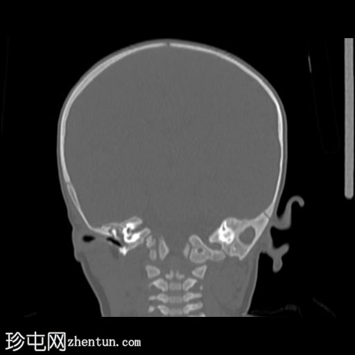 单侧冠状缝早闭