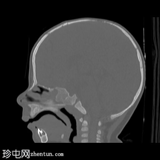 单侧冠状缝早闭