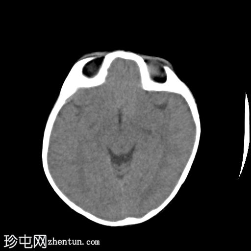 单侧冠状缝早闭