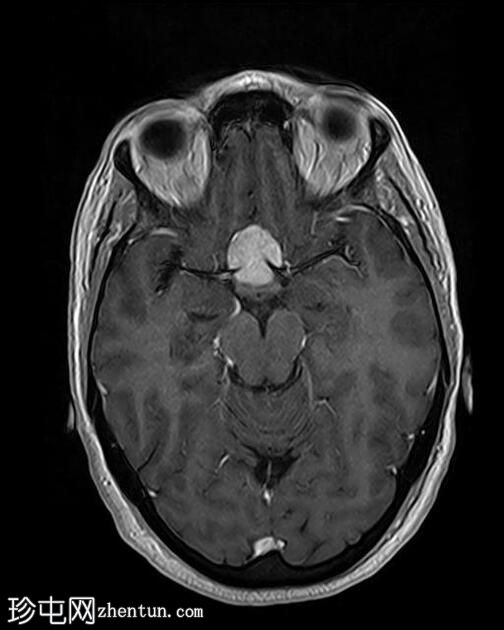 鞍结节脑膜瘤