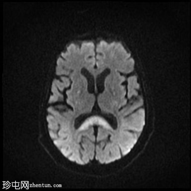 甲硝唑诱发的脑病