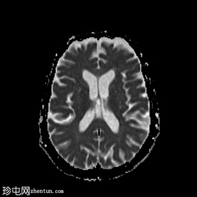 甲硝唑诱发的脑病