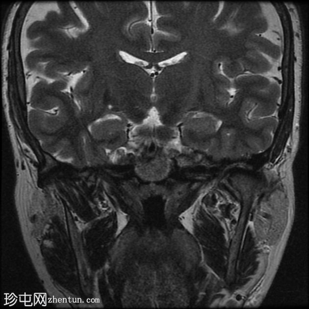 特发性颅内高压