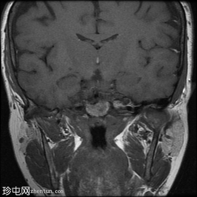 特发性颅内高压