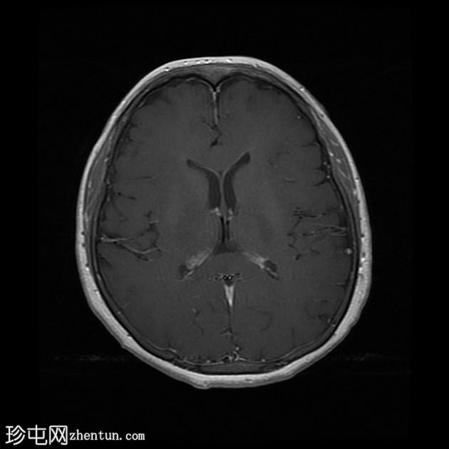 特发性颅内高压