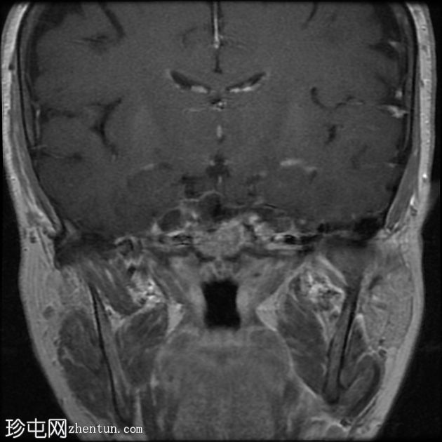 特发性颅内高压