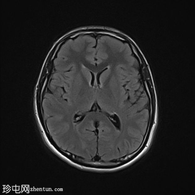 毛细血管扩张