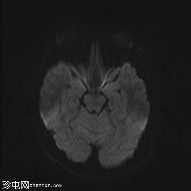 毛细血管扩张