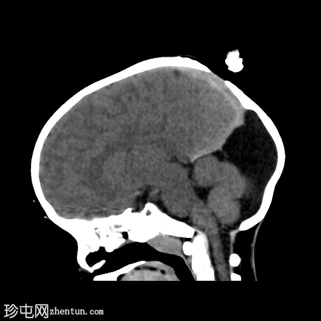 小脑后蛛网膜囊肿