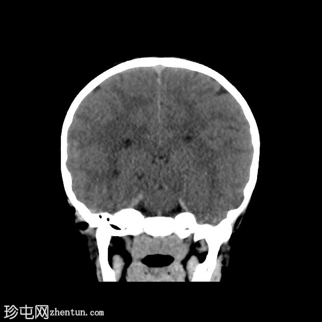 小脑后蛛网膜囊肿