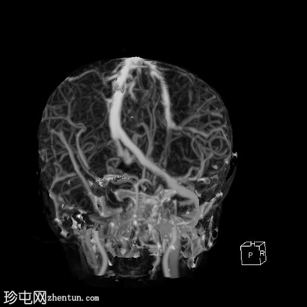 小脑后蛛网膜囊肿