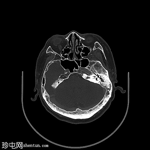 左腮腺Whartin瘤并发窦道