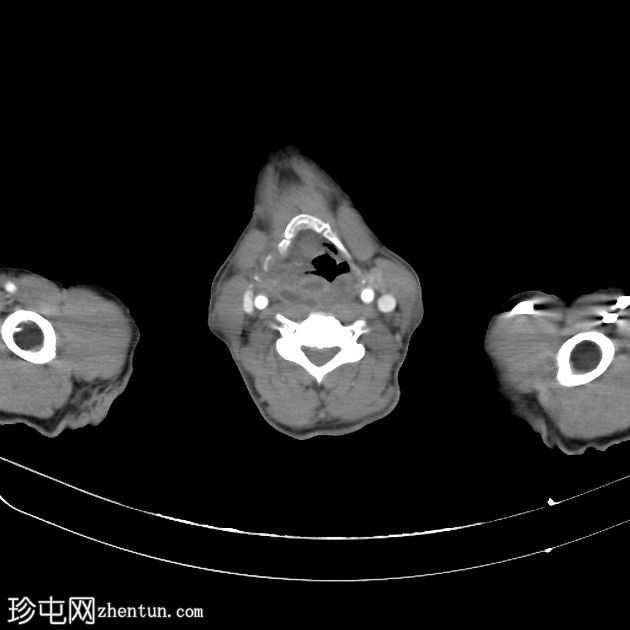 咽后脓肿延伸至纵隔