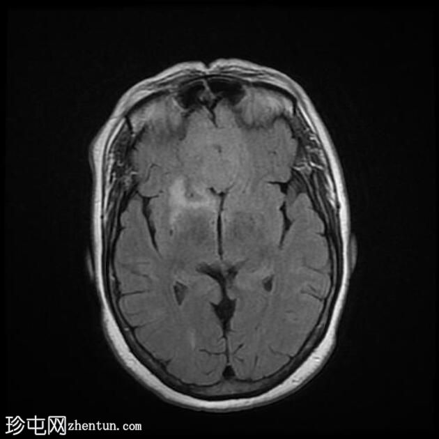 嗅神经母细胞瘤