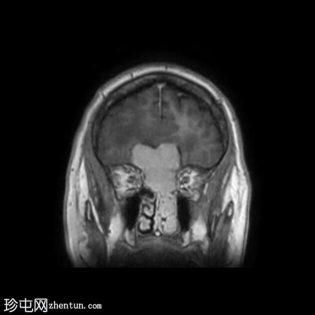 嗅神经母细胞瘤