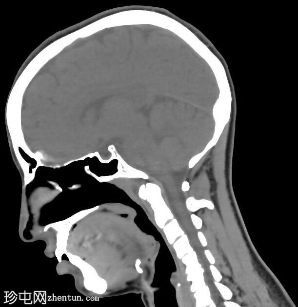 隆鼻和隆下巴