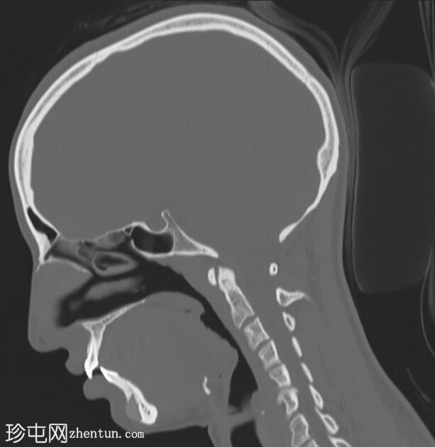 隆鼻和隆下巴