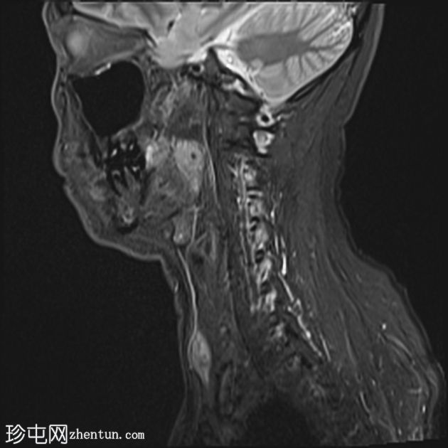 胸骨舌骨肌纤维瘤病