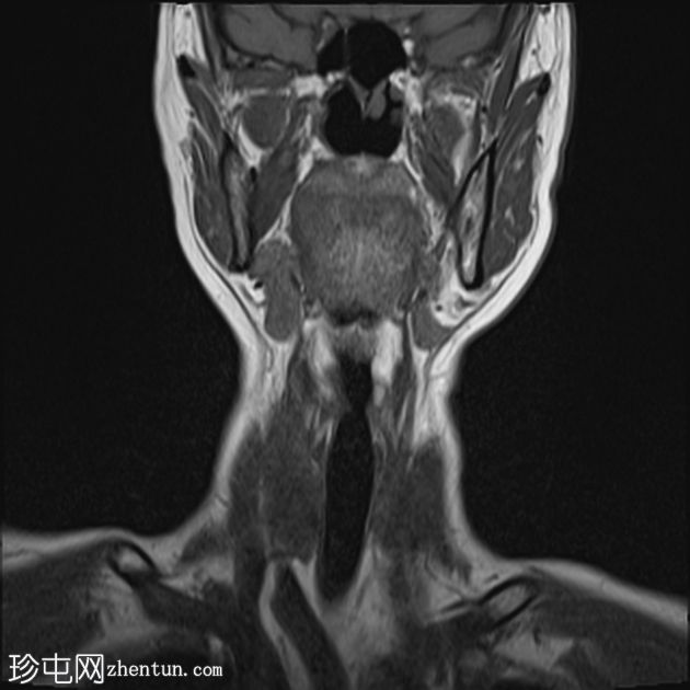 胸骨舌骨肌纤维瘤病