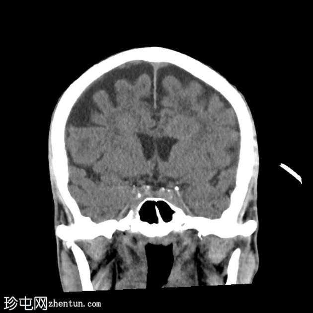 双侧额叶肿块和纵隔肿块