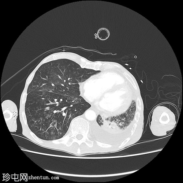 双侧额叶肿块和纵隔肿块