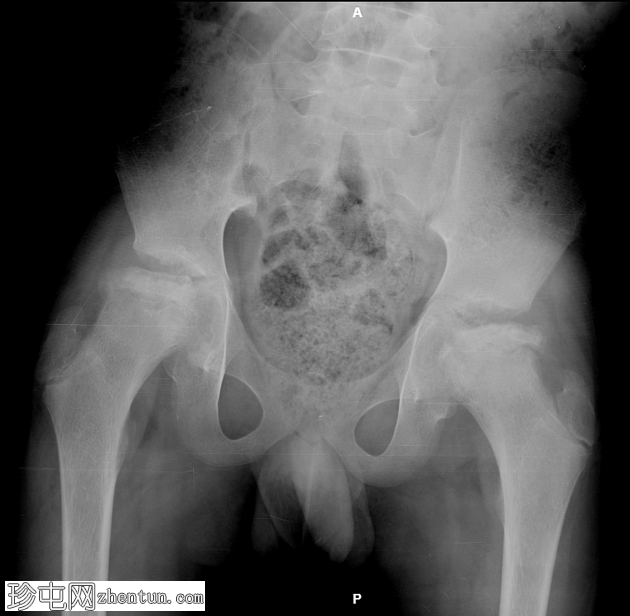 儿童双侧髋关节缺血性坏死一例