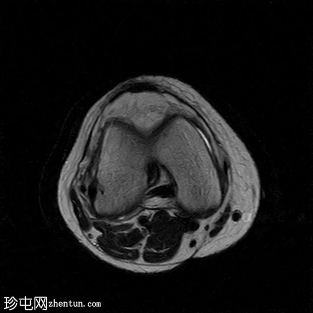 前交叉韧带撕裂