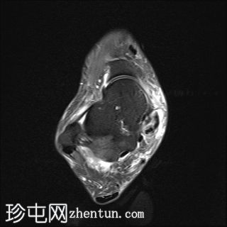 胫骨后肌功能障碍