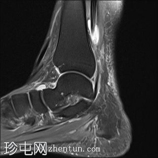 胫骨后肌功能障碍