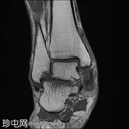 胫骨后肌功能障碍