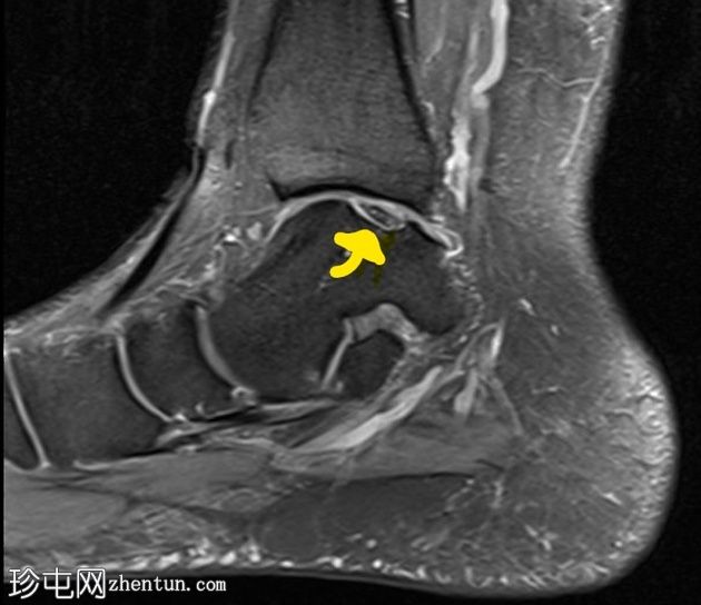 距骨内侧穹窿剥脱性骨软骨炎