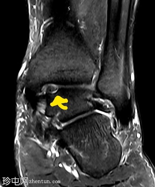 距骨内侧穹窿剥脱性骨软骨炎