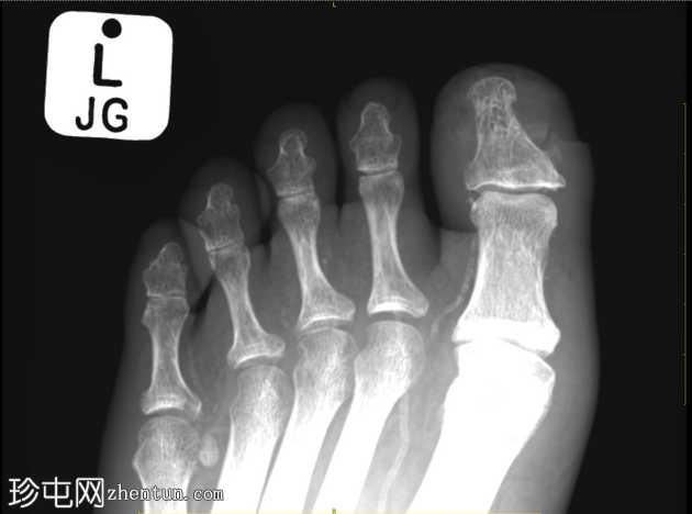 糖尿病蜂窝织炎和指关节病