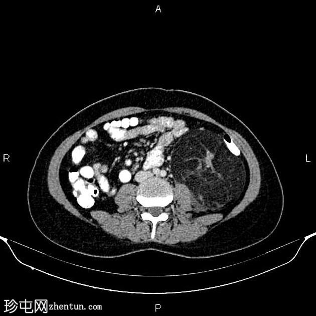 巨大肾血管平滑肌脂肪瘤