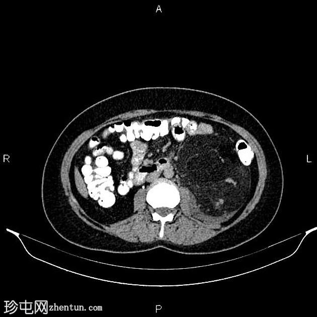 巨大肾血管平滑肌脂肪瘤