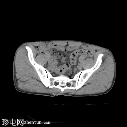 股直肌骨化性肌炎