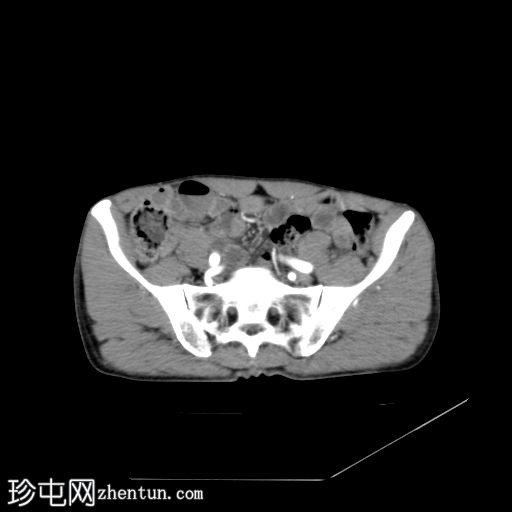 股直肌骨化性肌炎