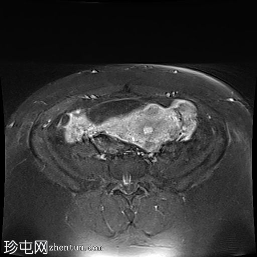 多发性子宫平滑肌瘤