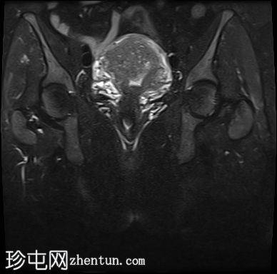 局灶性子宫腺肌病