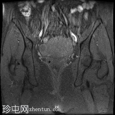 局灶性子宫腺肌病