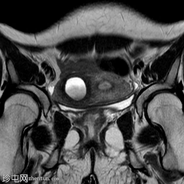 单侧子宫伴对侧残角非交通性子宫血肿