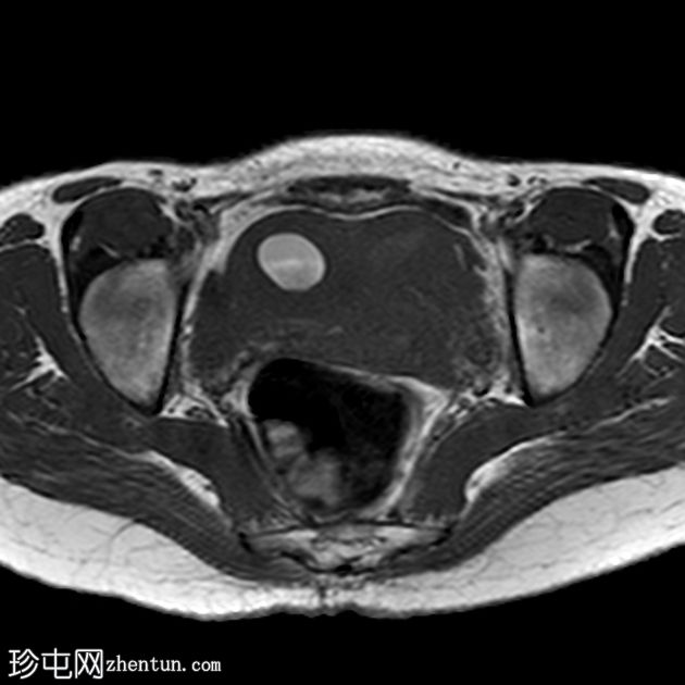 单侧子宫伴对侧残角非交通性子宫血肿