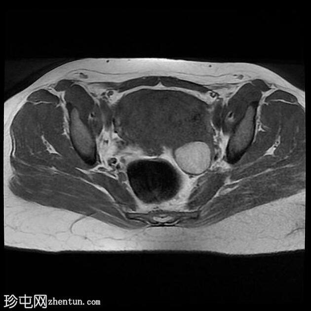 子宫腺肌病和子宫内膜异位囊肿