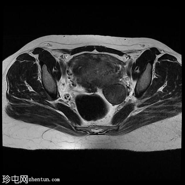 子宫腺肌病和子宫内膜异位囊肿