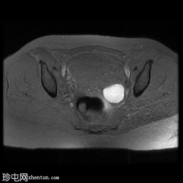 子宫腺肌病和子宫内膜异位囊肿