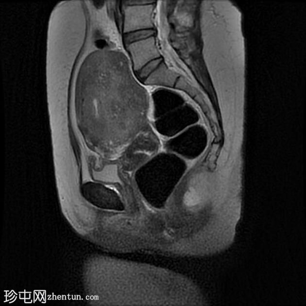 子宫腺肌病和子宫内膜异位囊肿