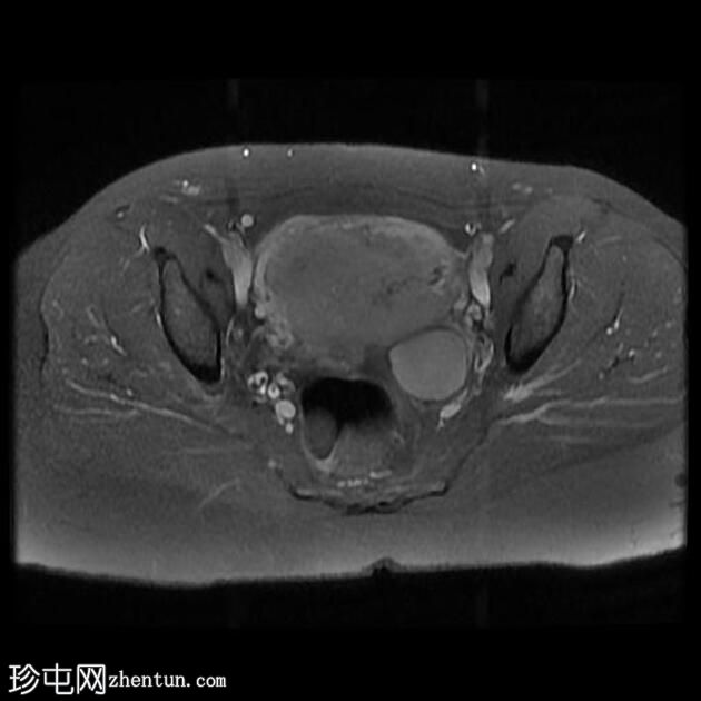 子宫腺肌病和子宫内膜异位囊肿