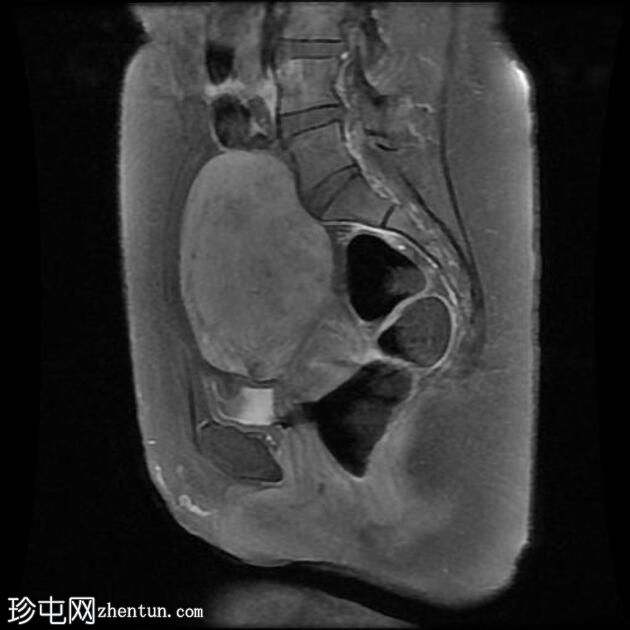 子宫腺肌病和子宫内膜异位囊肿