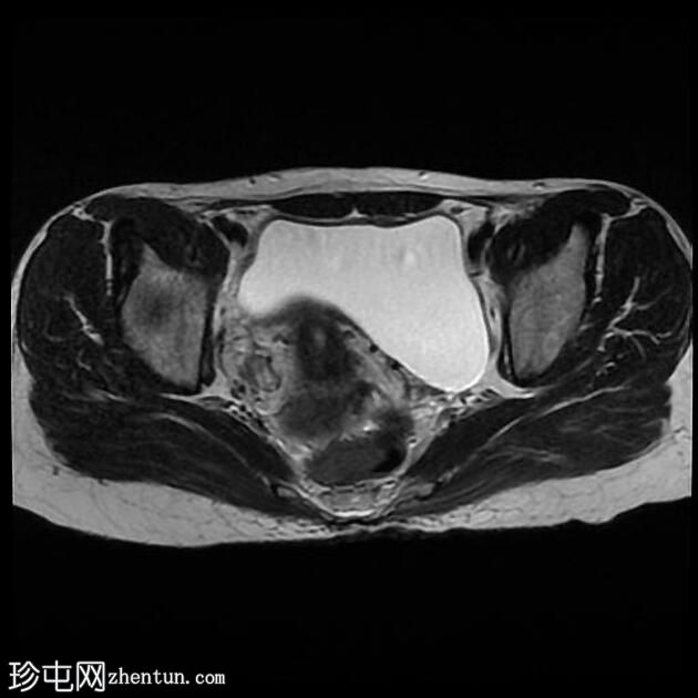 子宫内膜异位症 - T2 阴影征