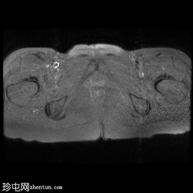 子宫内膜异位症 - T2 阴影征